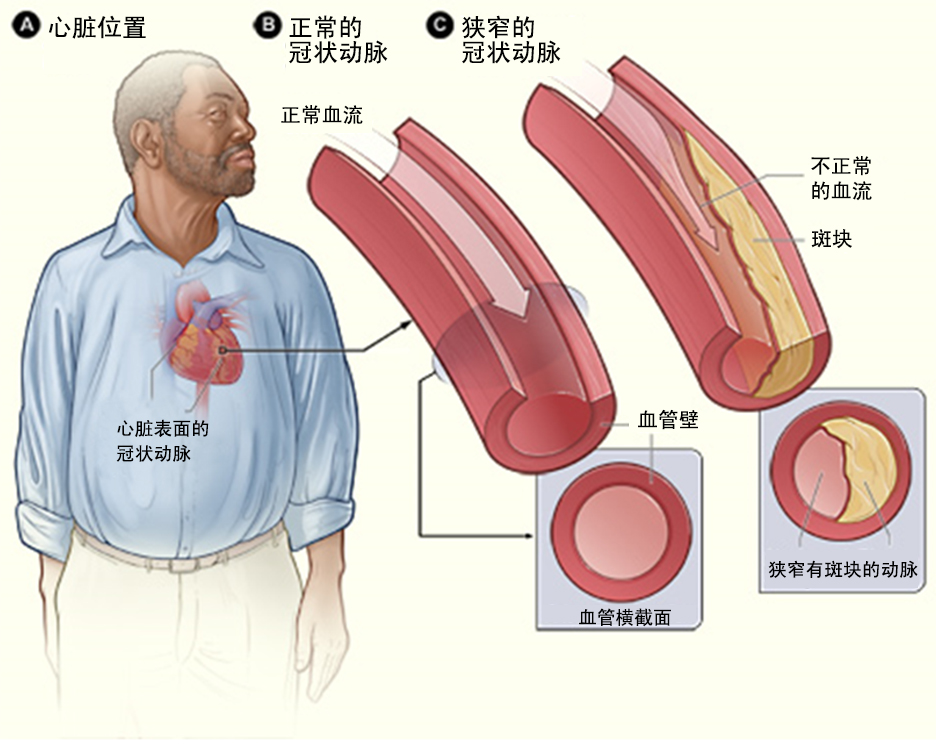 什么是冠心病?(圖1)