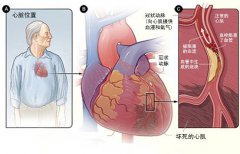 冠心病的起因是什么？